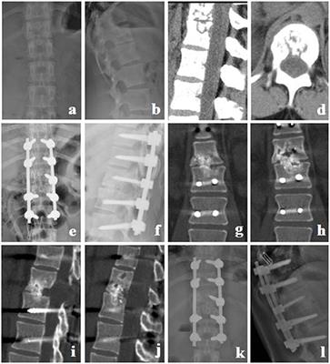 Comparison of Granular Bone Grafts and Transverse Process Bone Grafts for Single-Segmental Thoracic Tuberculosis: A Retrospective Single-Center Comparative Study